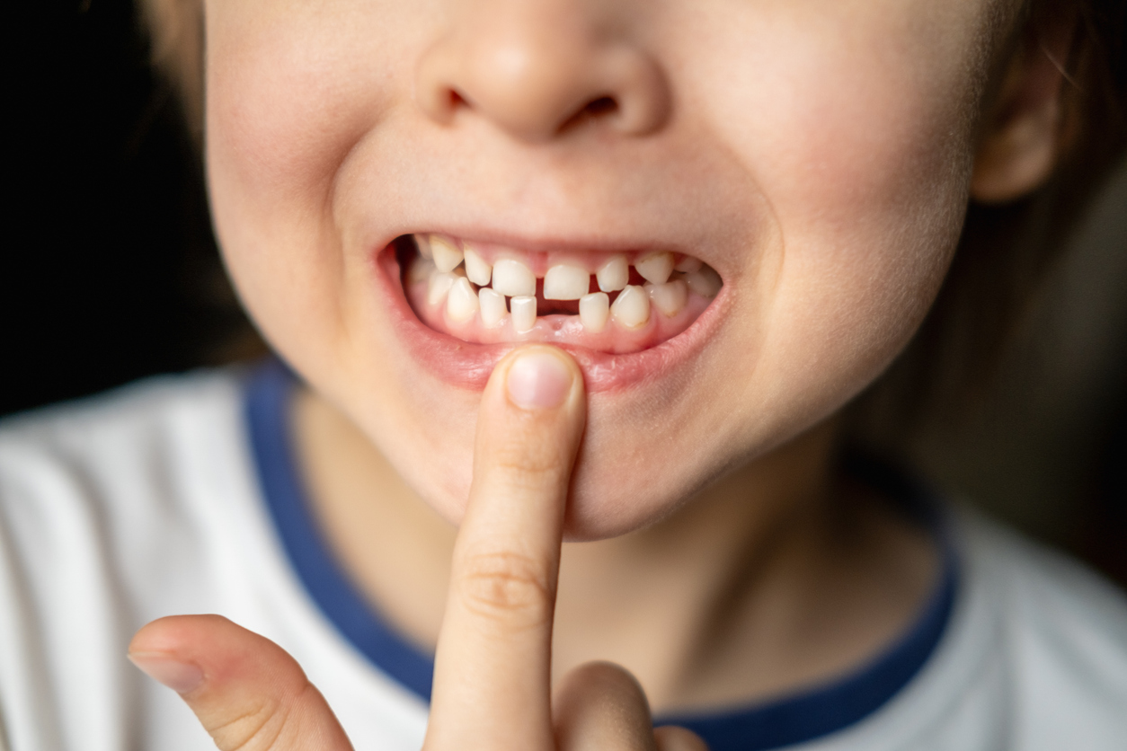 Portrait of little boy with open mouth without one front milk tooth. Loss of baby primary teeth. Waiting for growth of permanent molar tooth.